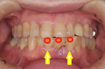 歯周病になり保存不可能な下の前歯3本を即時荷重を行った症例
