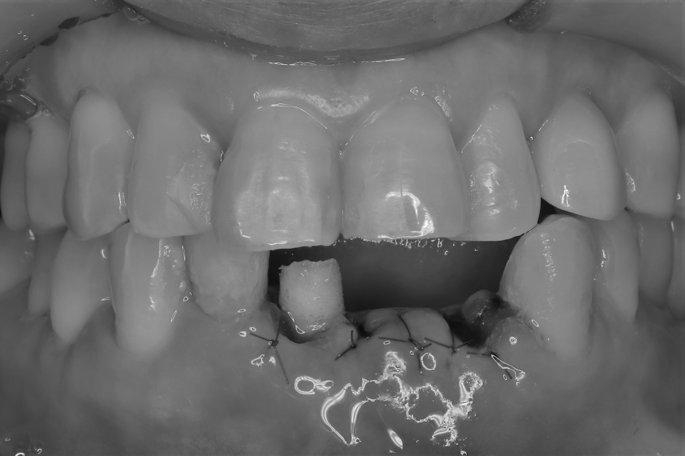 歯周病になり保存不可能な下の前歯3本を即時荷重を行った症例