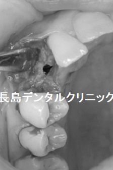 入れ歯にはなじめず右上犬歯1歯欠損に対して即時荷重インプラント埋入を行った症例