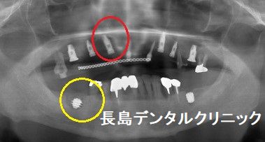 上顎奥歯と下顎奥歯の使用するインプラントを変える理由とは