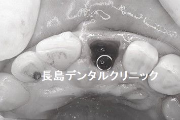 左上前歯の歯茎を切開せず抜歯と同時にインプラントを埋入し仮歯まで入る即時荷重インプラント埋入