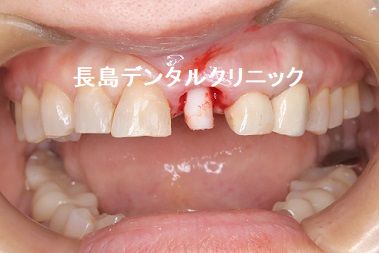 左上前歯の歯茎を切開せず抜歯と同時にインプラントを埋入し仮歯まで入る即時荷重インプラント埋入