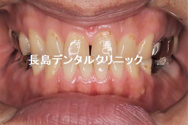 左下奥歯を抜歯し取り外し式の入れ歯から固定式のブリッジに変更した症例