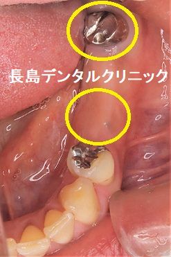 左下奥歯を抜歯し取り外し式の入れ歯から固定式のブリッジに変更した症例