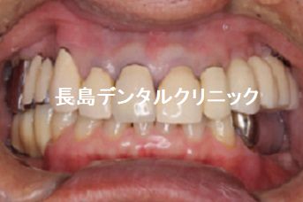 左下奥歯3本に対して2本インプラントを並べて埋入した症例