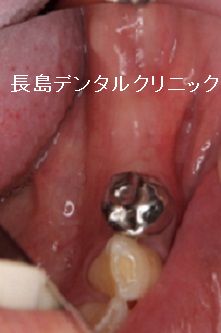 左下奥歯3本に対して2本インプラントを並べて埋入した症例