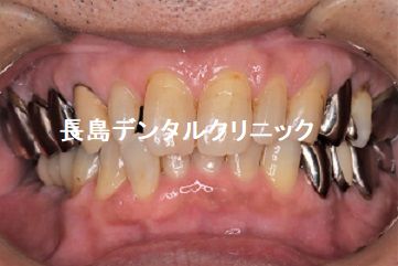 噛む力が大きく加わる下顎の奥歯にワイドタイプのショートインプラントを選択する分け理由①