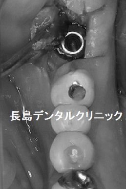 噛む力が大きく加わる下顎の奥歯にワイドタイプのショートインプラントを選択する分け理由①