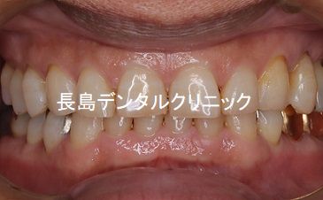 歯周病が大きく進んだ右下奥歯にインプラントを埋入した症例