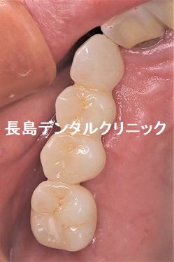 右上前歯から奥歯にかけて5本欠損された部位に3本のインプラントを使い4歯を入れた症例