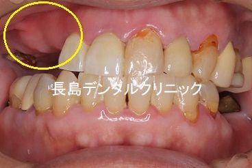 右上前歯から奥歯にかけて5本欠損された部位に3本のインプラントを使い4歯を入れた症例