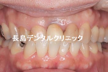 虫歯が進み差し歯にできない左下奥歯に抜歯即時インプラント埋入を行った症例
