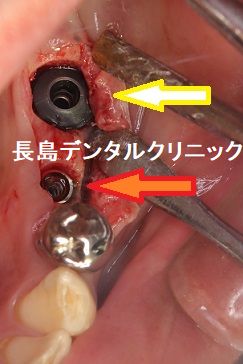 噛む力の強い患者様の左下奥歯にワイドタイプのショートインプラントを選択し治療を行った症例