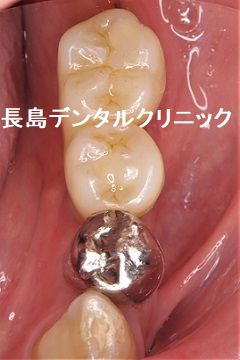 噛む力の強い患者様の左下奥歯にワイドタイプのショートインプラントを選択し治療を行った症例