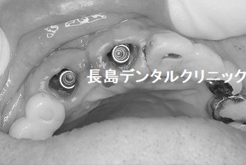 仮歯が入っている右上前歯を2本抜歯後即時荷重インプラント埋入を行いセラミックのインプラントブリッジを装着した症例