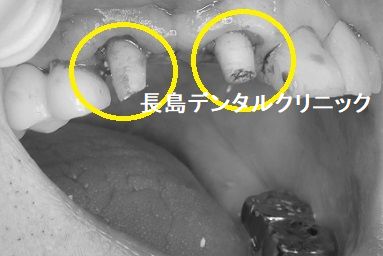 仮歯が入っている右上前歯を2本抜歯後即時荷重インプラント埋入を行いセラミックのインプラントブリッジを装着した症例