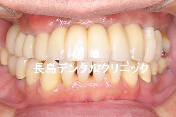 5本つながっている上の前歯のブリッジを抜歯しインプラントブリッジに取り換えた症例