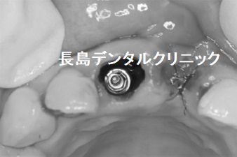 インプラント周囲炎の前歯のインプラントを撤去し即時荷重インプラント埋入を行った症例（治療途中）