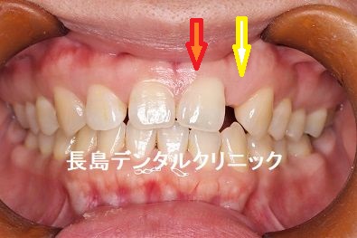 先生性欠損している左上前歯をインプラント、その隣をラミネートべニアで治療した症例