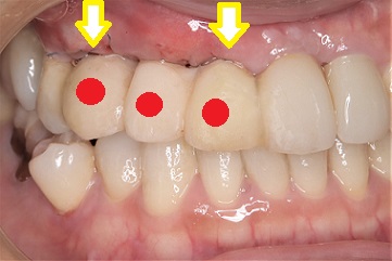 右上犬歯を含み前歯4本を抜歯し抜歯即時と同時にインプラントを埋入し仮歯を入れた患者様の1週間後の口腔内の状態