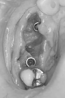 右上犬歯を含み前歯4本を抜歯し抜歯即時と同時にインプラントを埋入し仮歯を入れた患者様の1週間後の口腔内の状態