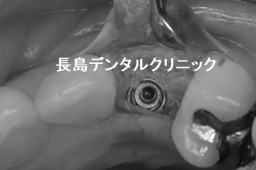 左上前歯（犬歯）に即時荷重インプラント埋入を行いその日のうちに仮歯を装着した症例