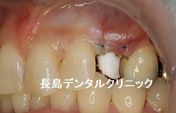 左上前歯（犬歯）に即時荷重インプラント埋入を行いその日のうちに仮歯を装着した症例