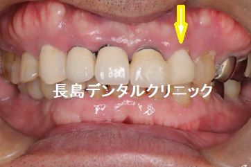 咬み合わせが非常に強く上の前歯を1本抜歯即時インプラント埋入した症例