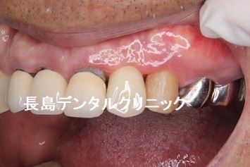 咬み合わせが非常に強く上の前歯を1本抜歯即時インプラント埋入した症例
