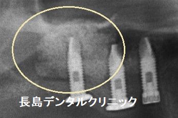 グラフトレスのインプラント治療とは患者様にやさしい治療方法です。