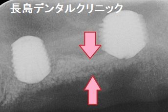 グラフトレスのインプラント治療とは患者様にやさしい治療方法です。