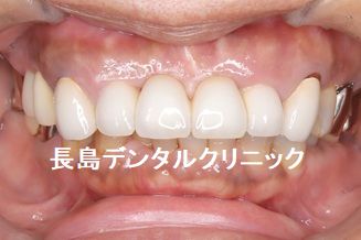 右上前歯から奥歯にかけて4歯欠損に対して2本のインプラントを使いインプラントブリッジを装着した症例