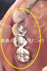 右上前歯から奥歯にかけて4歯欠損に対して2本のインプラントを使いインプラントブリッジを装着した症例