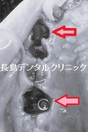 右上前歯から奥歯にかけて4歯欠損に対して2本のインプラントを使いインプラントブリッジを装着した症例