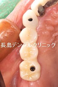 右上前歯から奥歯にかけて4歯欠損に対して2本のインプラントを使いインプラントブリッジを装着した症例