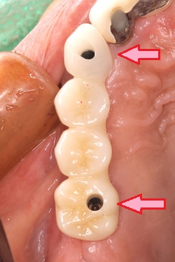 スクリュー固定のインプラントブリッジとセメント固定のインプラントブリッジの長所と短所