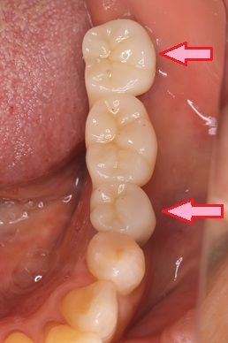 スクリュー固定のインプラントブリッジとセメント固定のインプラントブリッジの長所と短所