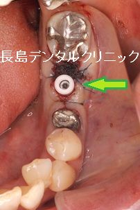 下顎奥歯の即時荷重インプラント埋入の治療の流れ