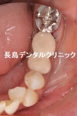 下顎奥歯の即時荷重インプラント埋入の治療の流れ