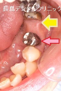 下顎奥歯の即時荷重インプラント埋入の治療の流れ