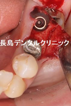 下顎奥歯の即時荷重インプラント埋入の治療の流れ