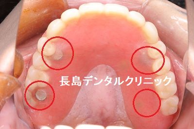保険適応で製作したインプラントオーバーデンチャーには義歯が破折しやすい