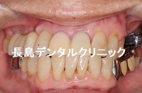 ノンクラスプデンチャーからインプラント2本を使い右上奥歯にインプラントブリッジを装着した症例