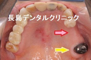 ノンクラスプデンチャーからインプラント2本を使い右上奥歯にインプラントブリッジを装着した症例