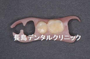 ノンクラスプデンチャーからインプラント2本を使い右上奥歯にインプラントブリッジを装着した症例