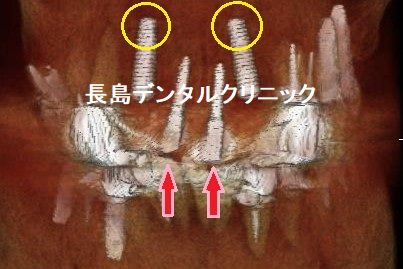 即時荷重ができないので上の前歯の仮歯を暫間インプラントで固定した症例
