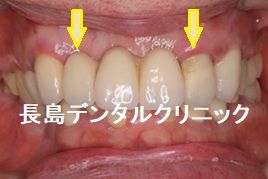 即時荷重ができないので上の前歯の仮歯を暫間インプラントで固定した症例