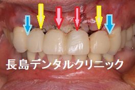 即時荷重ができないので上の前歯の仮歯を暫間インプラントで固定した症例