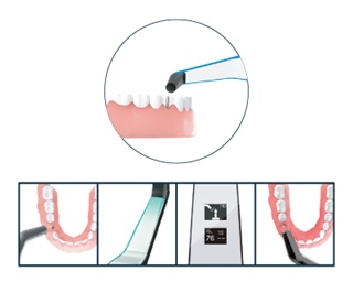 インプラント安定指数(ISQ)とは