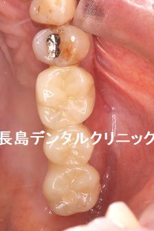 骨が非常に薄い上顎奥歯に人工骨を使わない(グラフトレス)インプラント治療